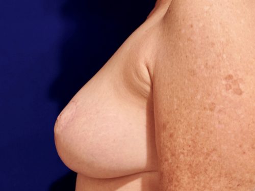 Breast Reduction 04 After 3