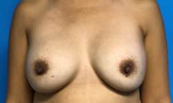 Breast Implant Exchange 07 Before