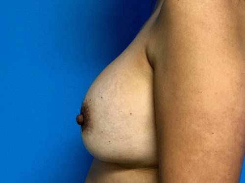 Breast Implant Exchange 07 Before 3