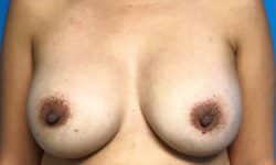 Breast Implant Exchange 07 After