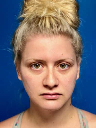 FaceTite 02 Before 1