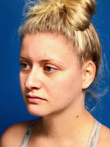 FaceTite 02 Before 2