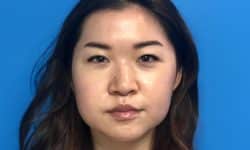 Buccal Fat Removal 08 After