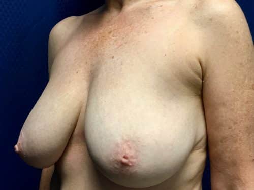 Breast Reduction 04 Before 2