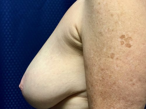 Breast Reduction 04 Before 3