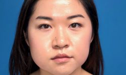 Buccal Fat Removal 08 Before