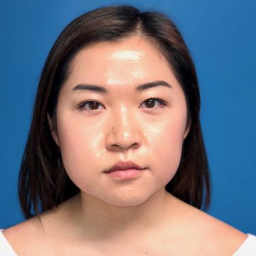 Buccal Fat Removal 08 Before 1