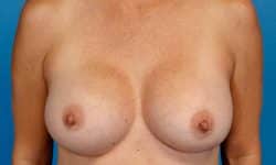 Breast Augmentation 16 After
