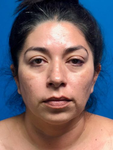 FaceTite 01 Before 1