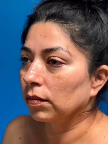 FaceTite 01 Before 2