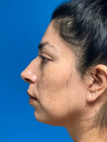 FaceTite 01 Before 3