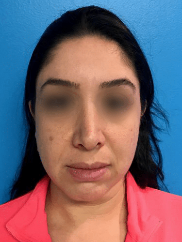 FaceTite 03 Before 1