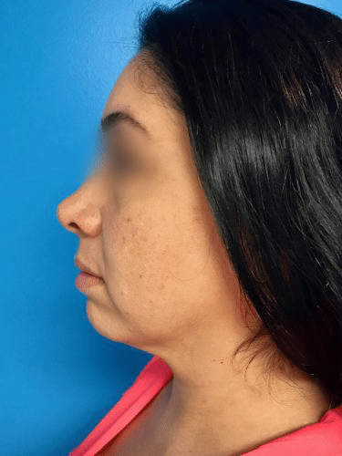 FaceTite 03 Before 3