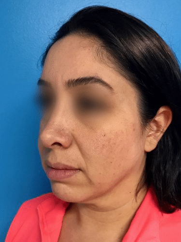 FaceTite 03 Before 2