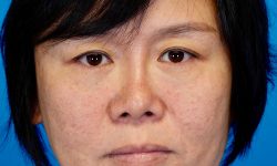 Buccal Fat Removal 09 Before