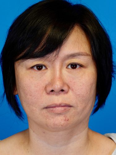 Buccal Fat Removal 09 Before 1