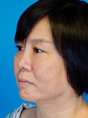 Buccal Fat Removal 09 Before 2