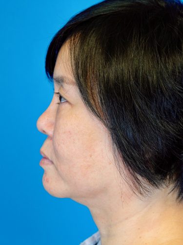 Buccal Fat Removal 09 Before 3