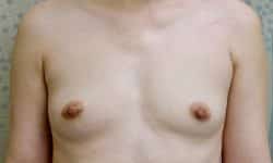 Breast Augmentation 18 Before