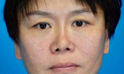 Buccal Fat Removal 09 After