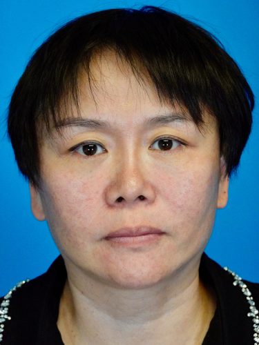 Buccal Fat Removal 09 After 1