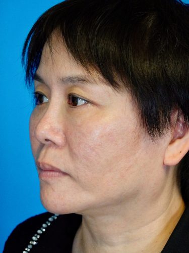 Buccal Fat Removal 09 After 2