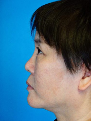 Buccal Fat Removal 09 After 3