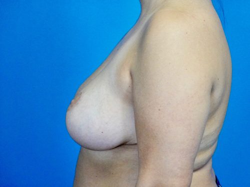 Breast Reduction 05 After 3