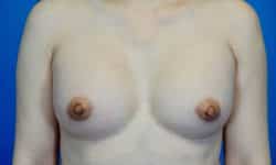 Breast Augmentation 18 After