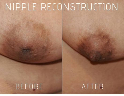 Nipple Reconstruction Before and After Photos 