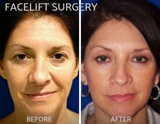 FACELIFT SURGERY-img-blog