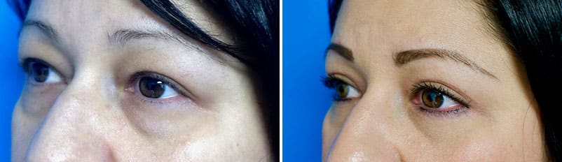 Before and after patient Eyelid Surgery side view