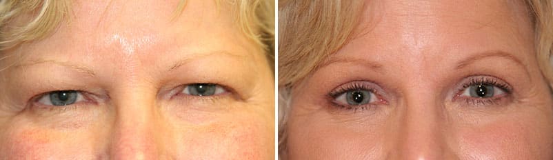 Before and after patient Eyelid Surgery