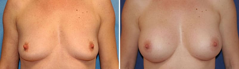 breast augmentation before and after