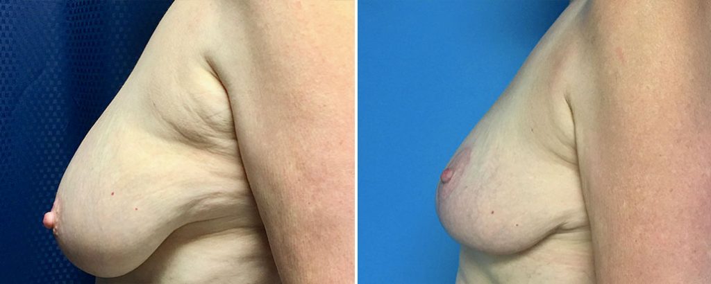 Before and after breast lift patient side view