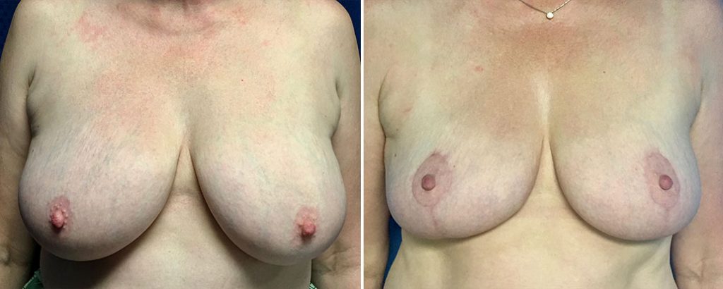 Before and after breast lift patient 