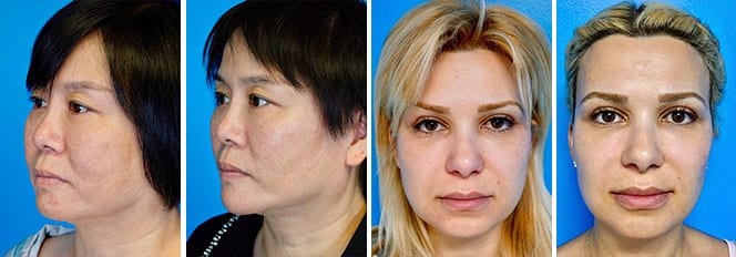 two before and after patients buccal fat removal