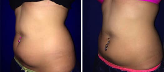 Before and after Coolsculpting patient side view