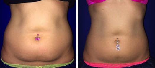 Coolsculpting before and after