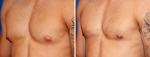 Before and after gynecomastia side view