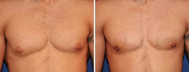 Before and after gynecomastia