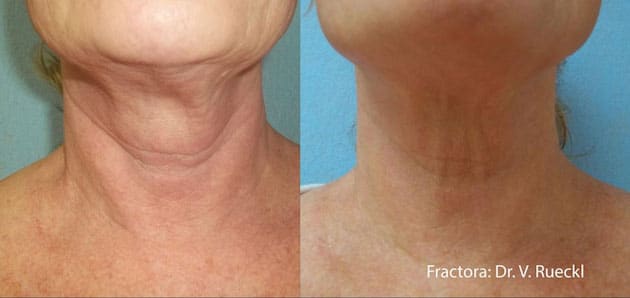 Fractora before and after Courtesy of Dr. V. Ruecki