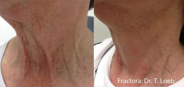 Fractora before and after Courtesy of Dr. T. Leob