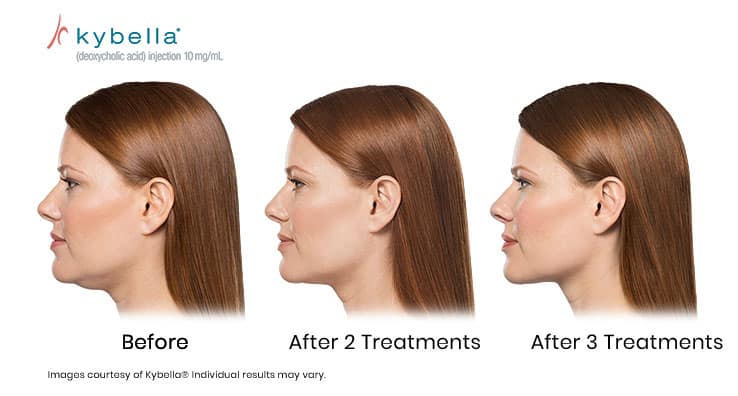 Before and after two, and three treatments of Kybella Courtesy of Kybella. Results may vary