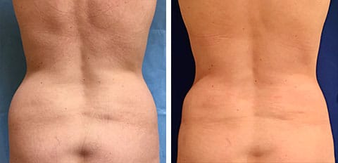 Before and After Liposuction patient view of the back