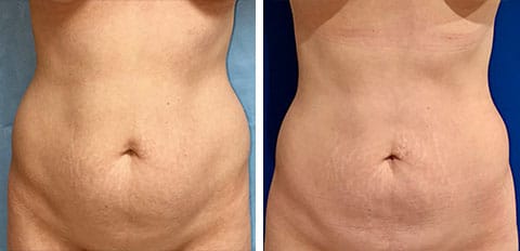 Before and After Liposuction patient