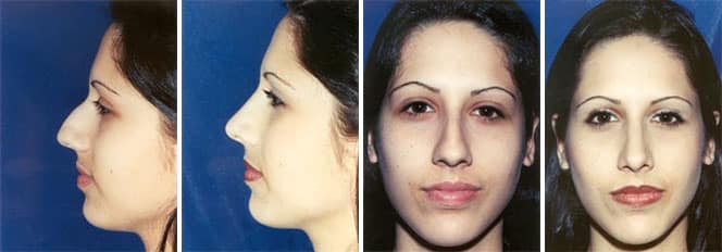 Rhinoplasty patient before and after front and side view