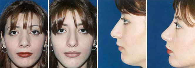 Rhinoplasty patient before and after front and side view