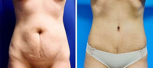 before and after tummy tuck patient