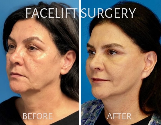 Woman before and after facelift surgery